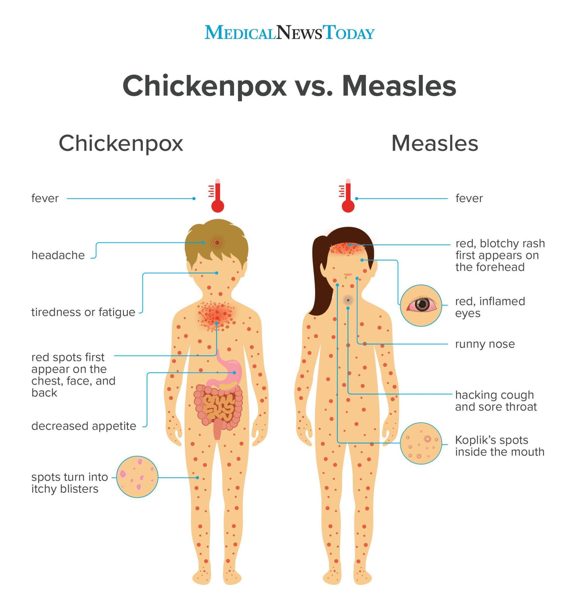 Measles highest in 25 years in Europe, WHO says