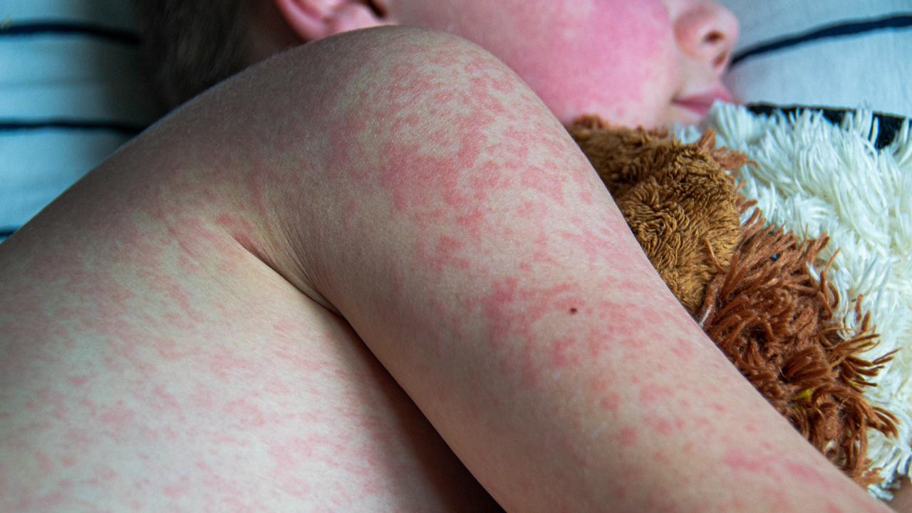 Factors Contributing to the Measles ⁣Resurgence